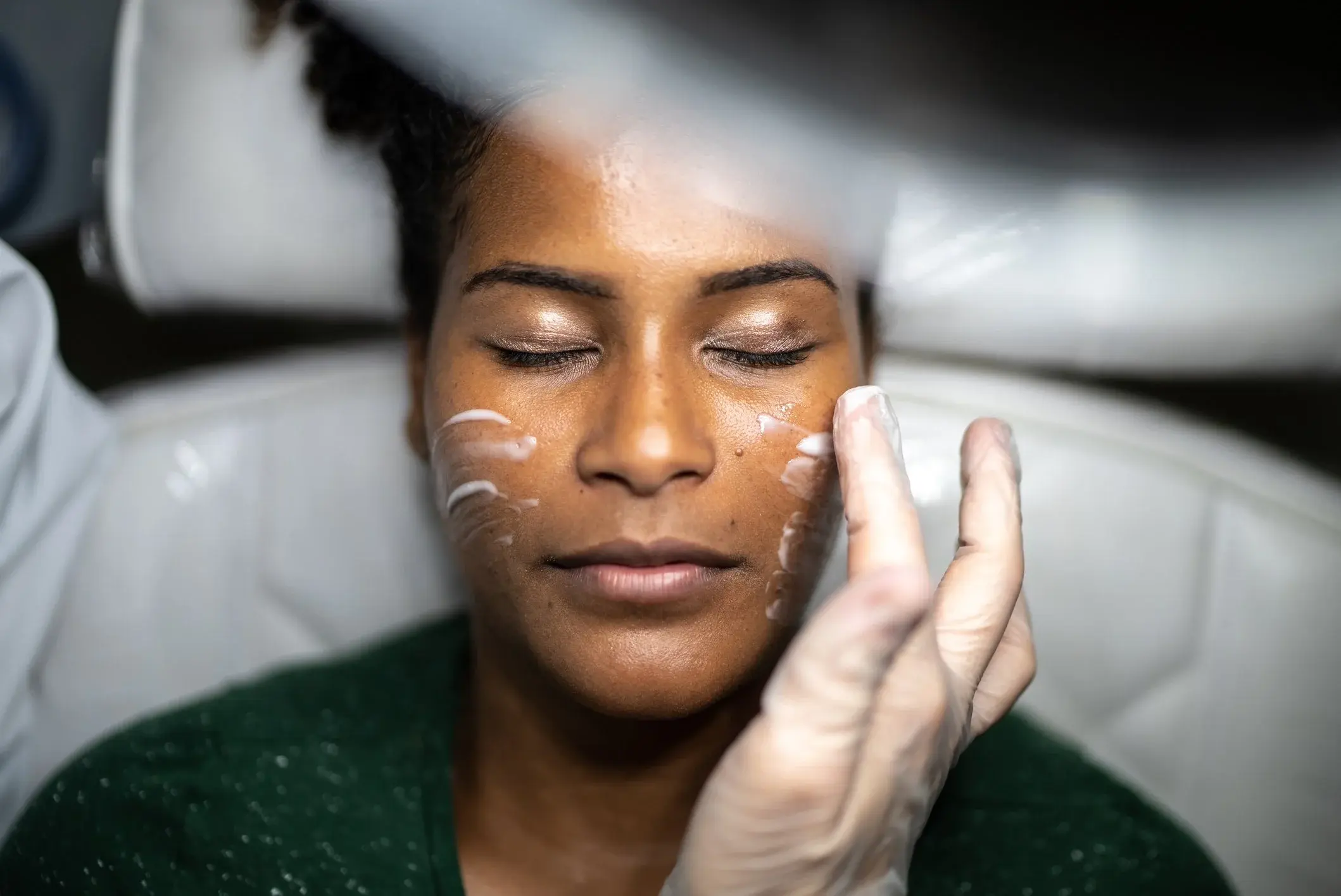 Chemical peel treatment
