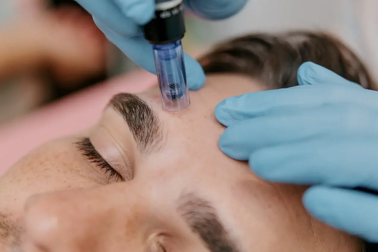 Microneedling treatment