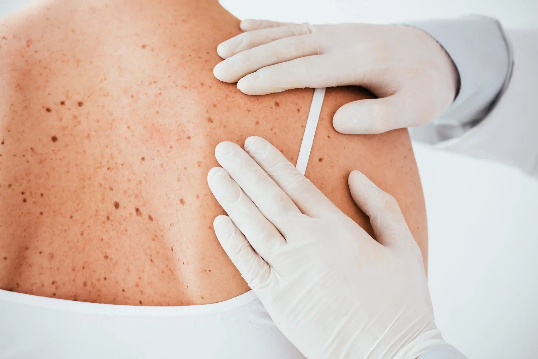 Skin cancer examination