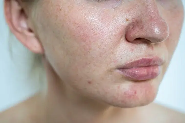 Woman with rosacea