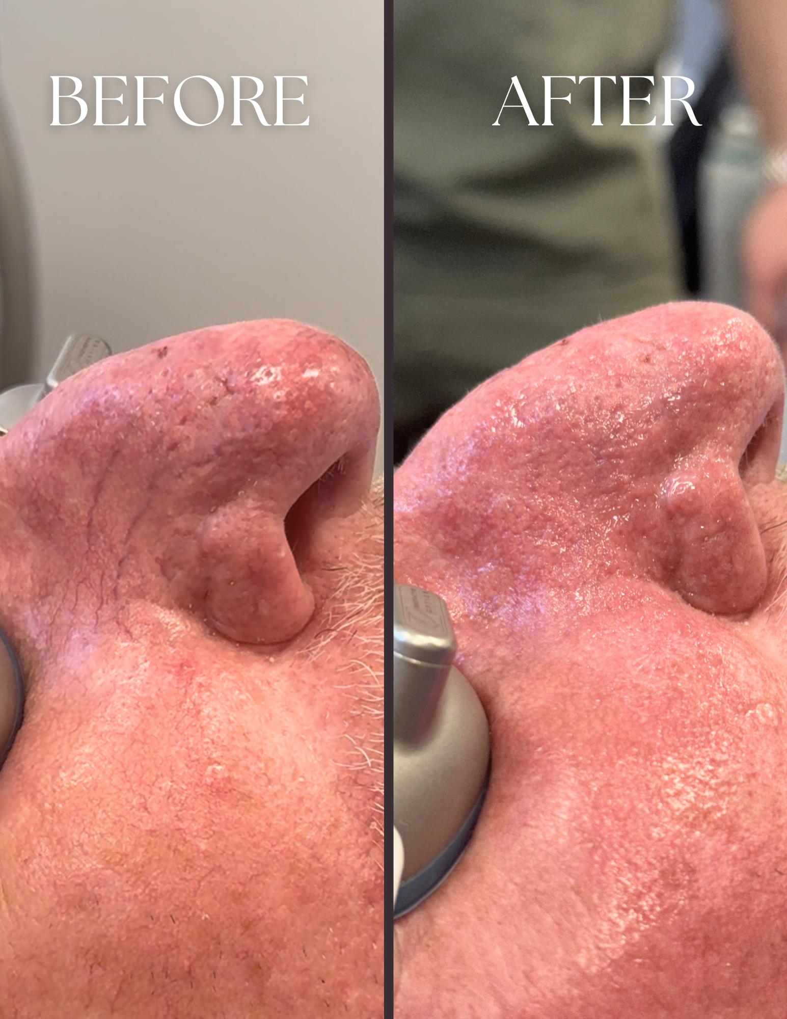 BBL HEROic Spot Treatment before and after
