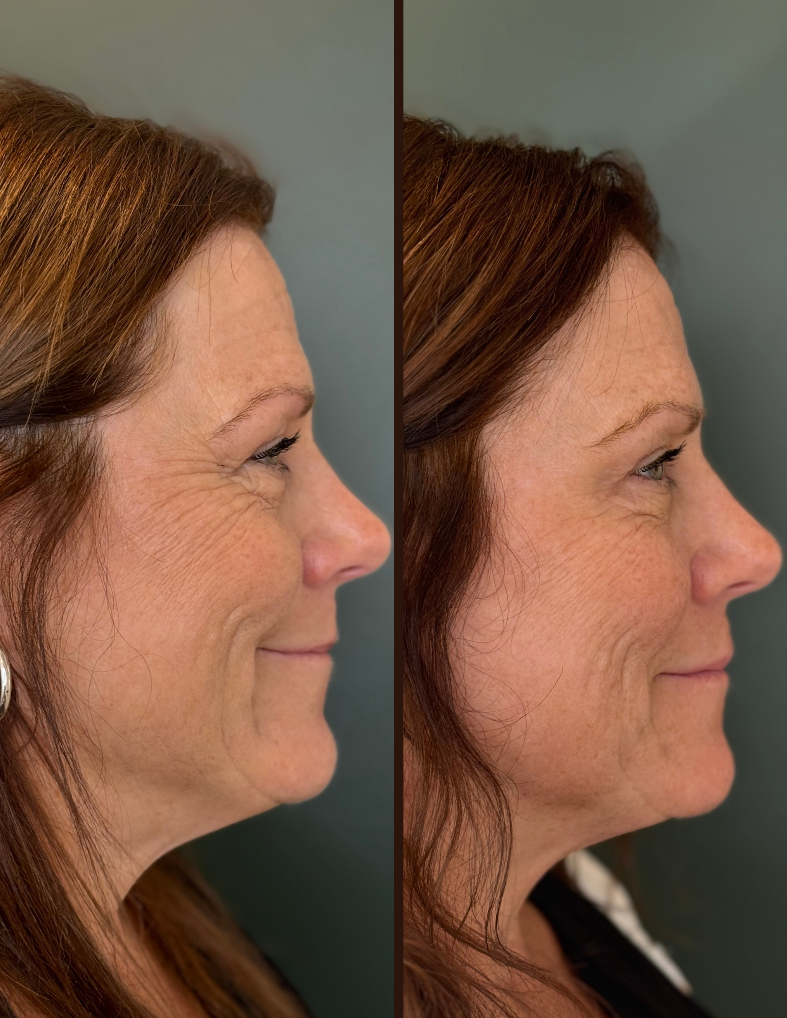 Botox before and after - Side view