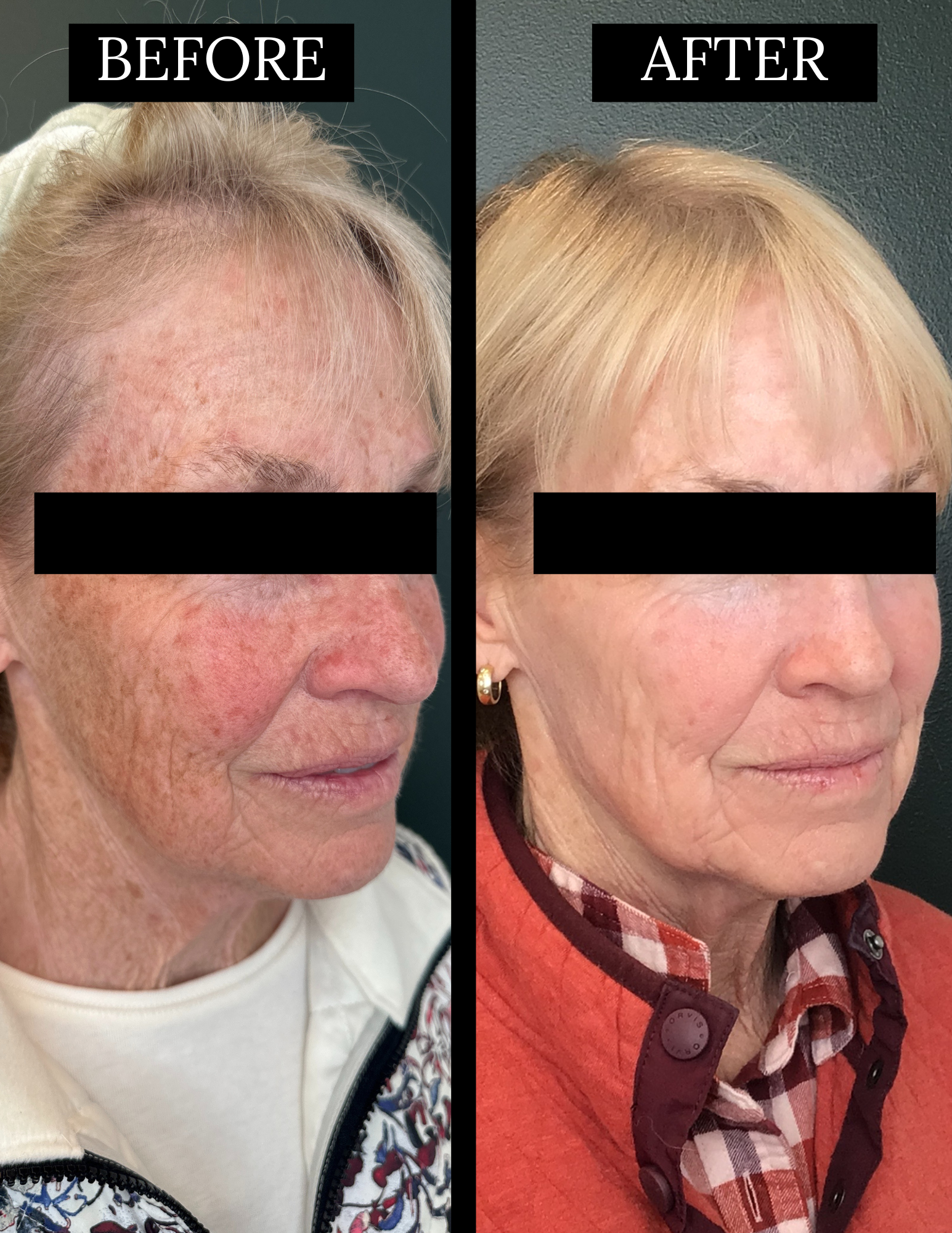 CO2 x BBL laser before and after - 45 degree