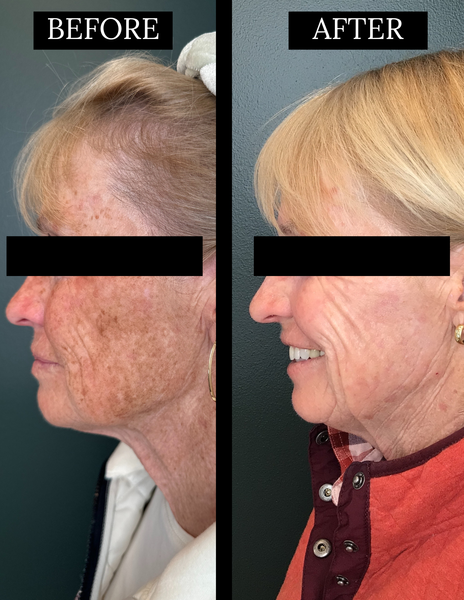 CO2 x BBL laser before and after - Right view