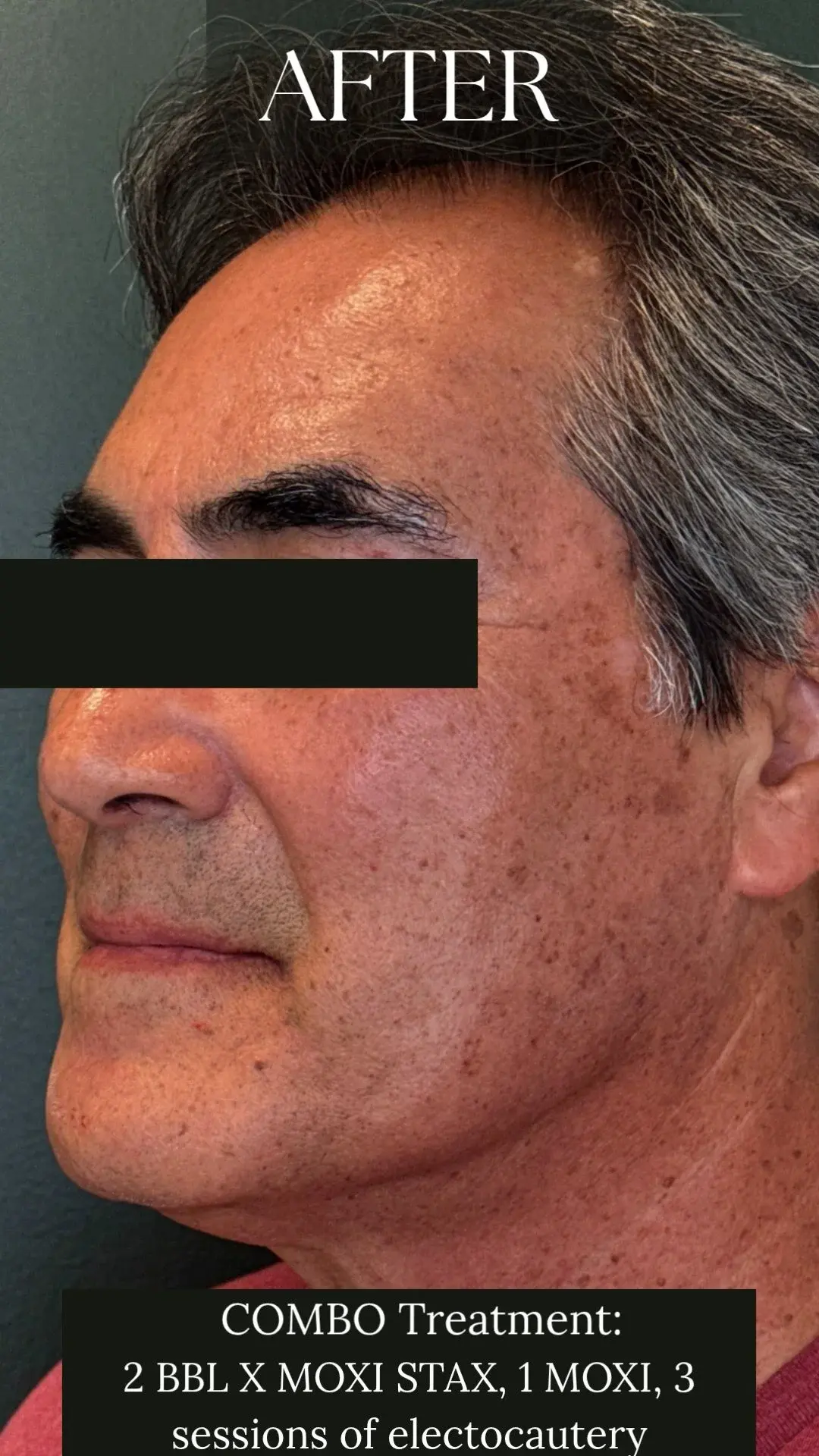 MOXI Treatment - After