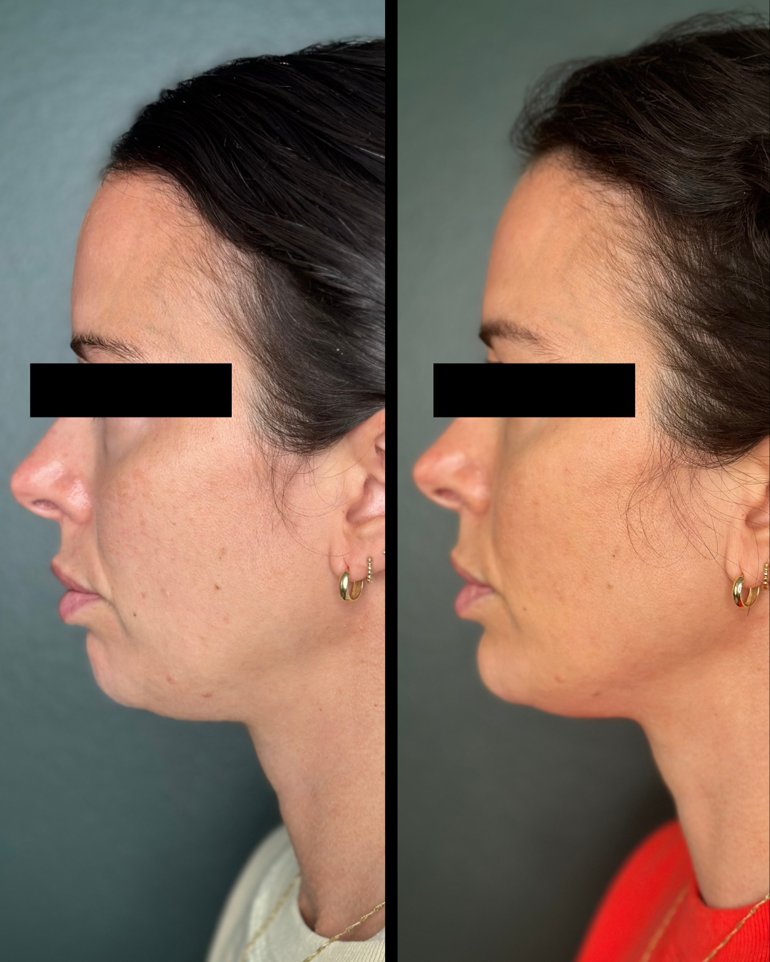 Sculptra before and after - Right side