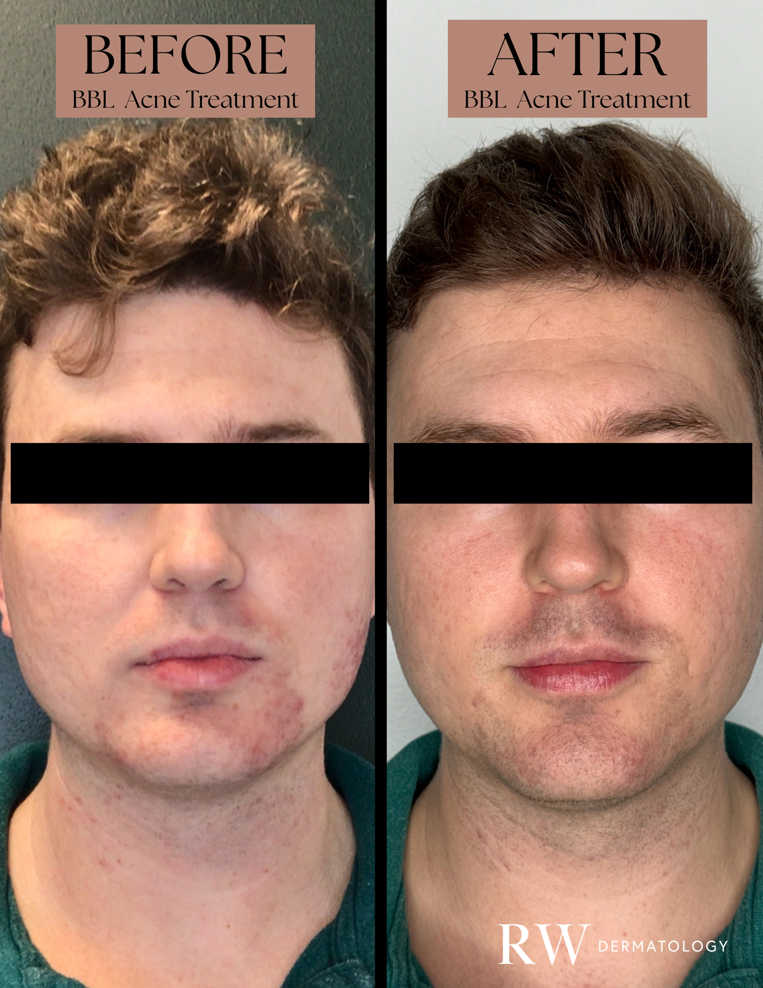 BBL HEROic Forever Clear - 6 Treatments (Front)