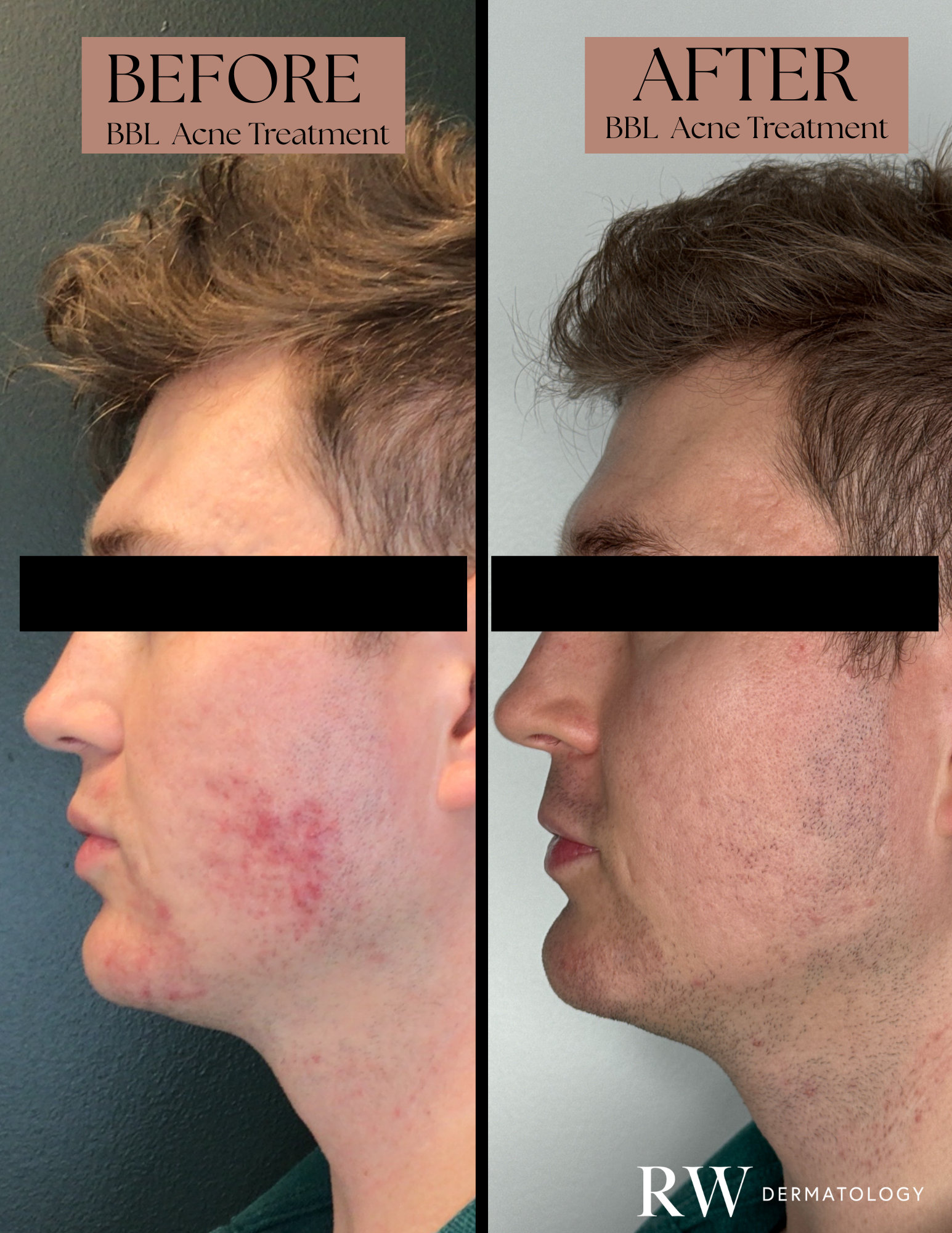 BBL HEROic Forever Clear - 6 Treatments (Right)