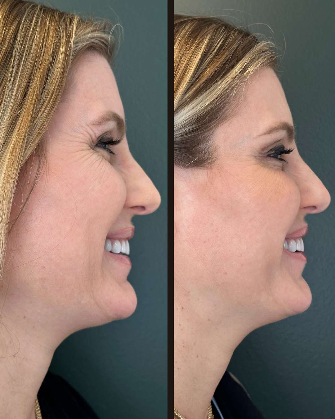 Botox before and after - Crow's feet