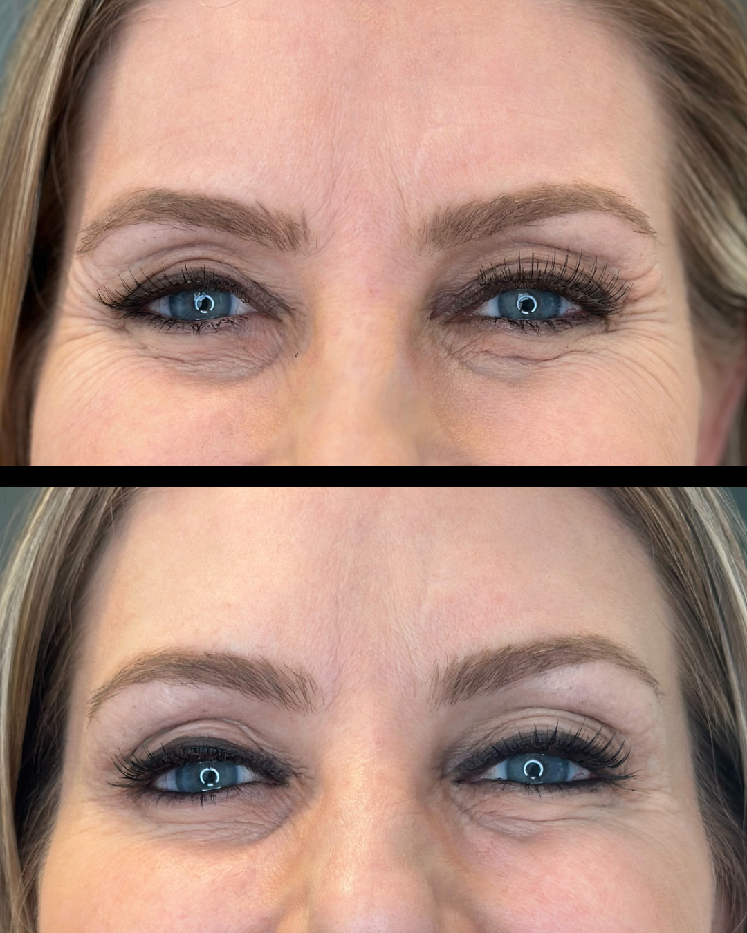 Dysport before and after - Eyes