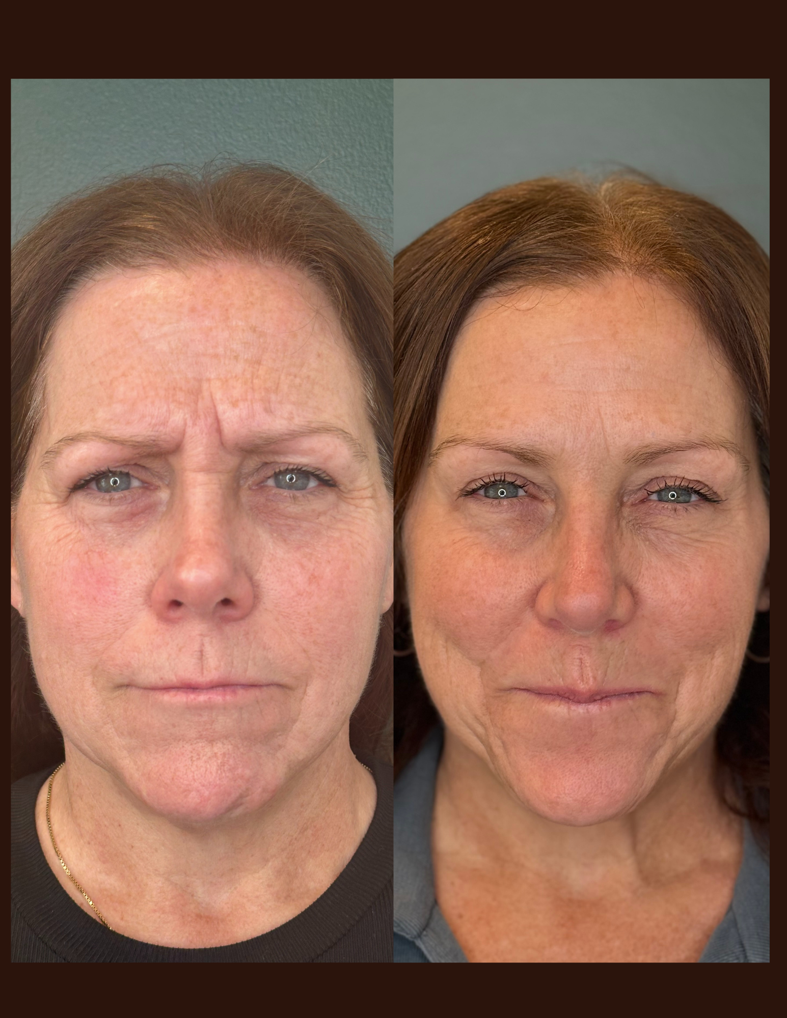 Botox before and after - Front view #2