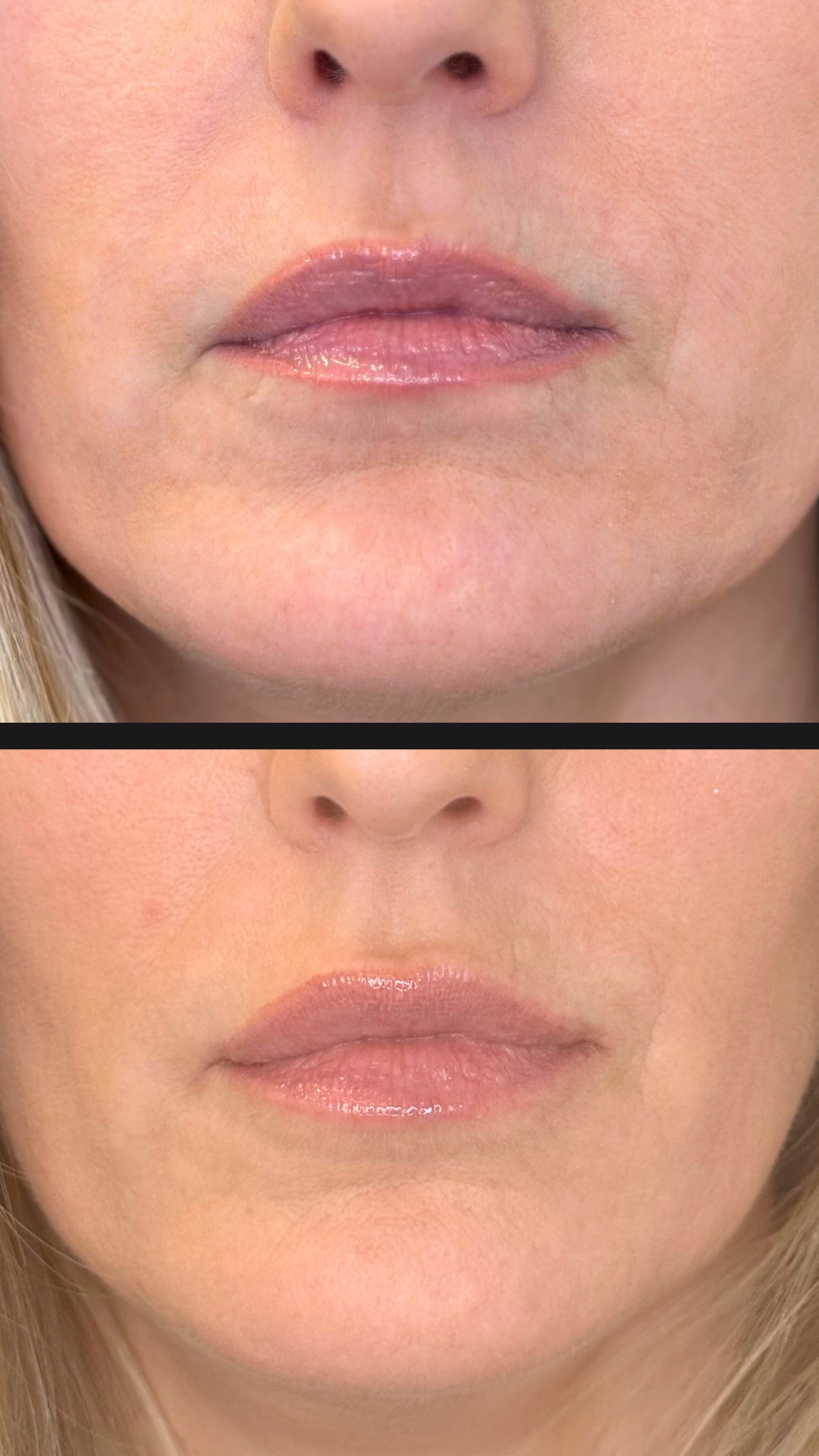 Lip filler before and after