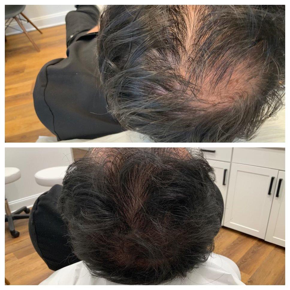 PRP hair treatment before and after