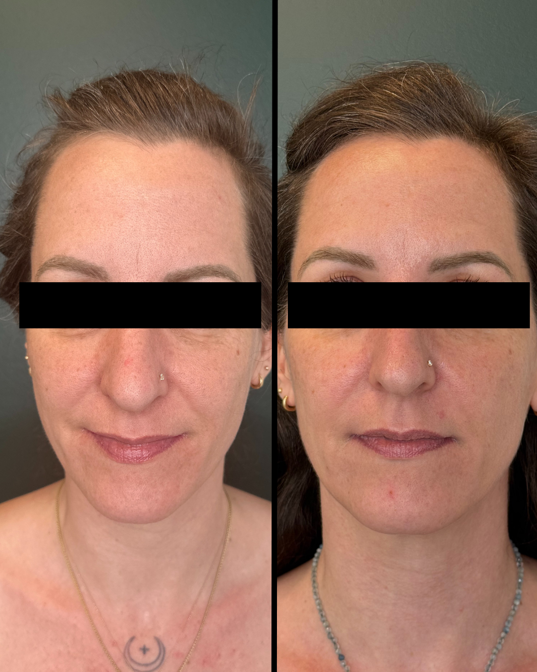 Sculptra before and after - Front view