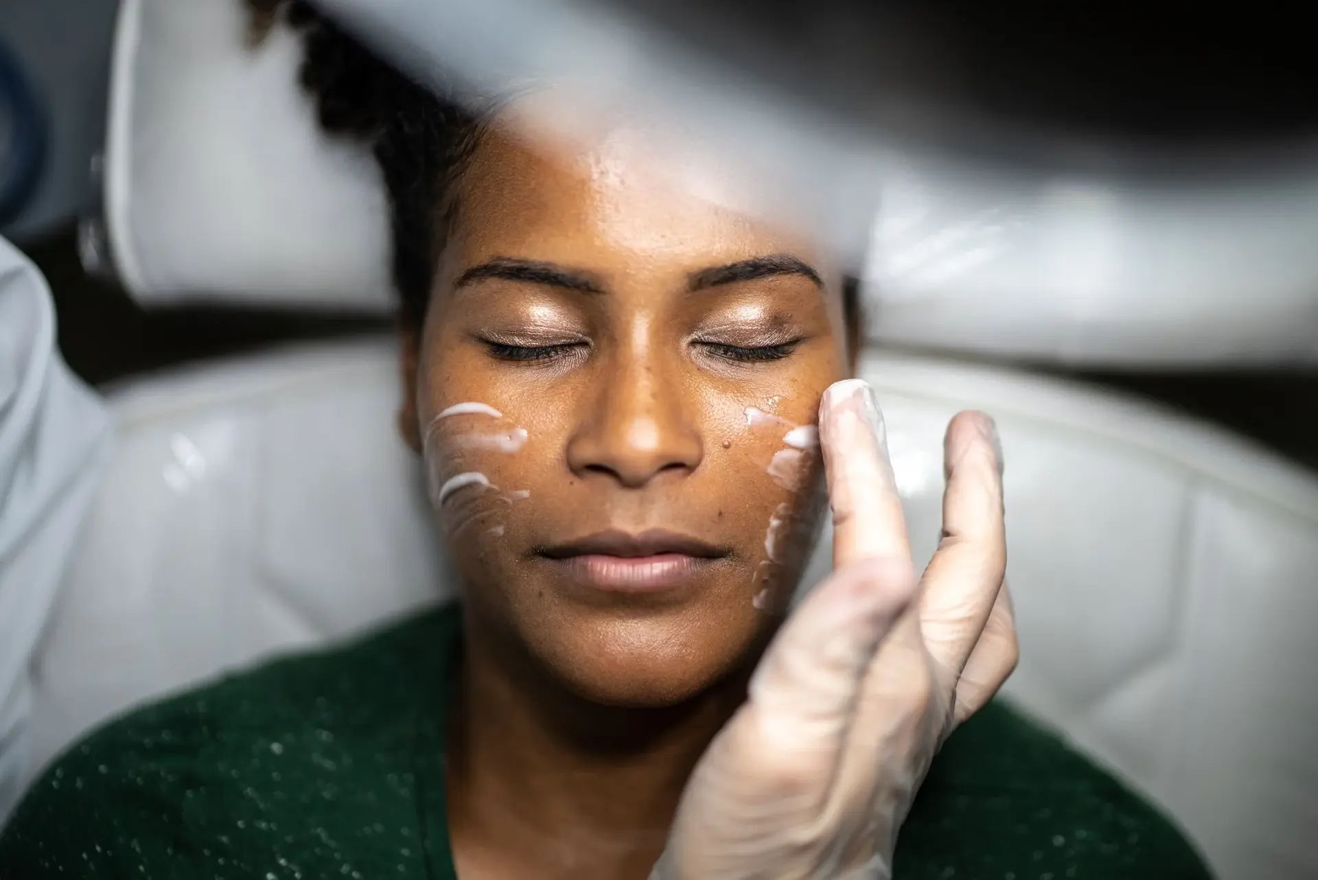 Chemical peel treatment