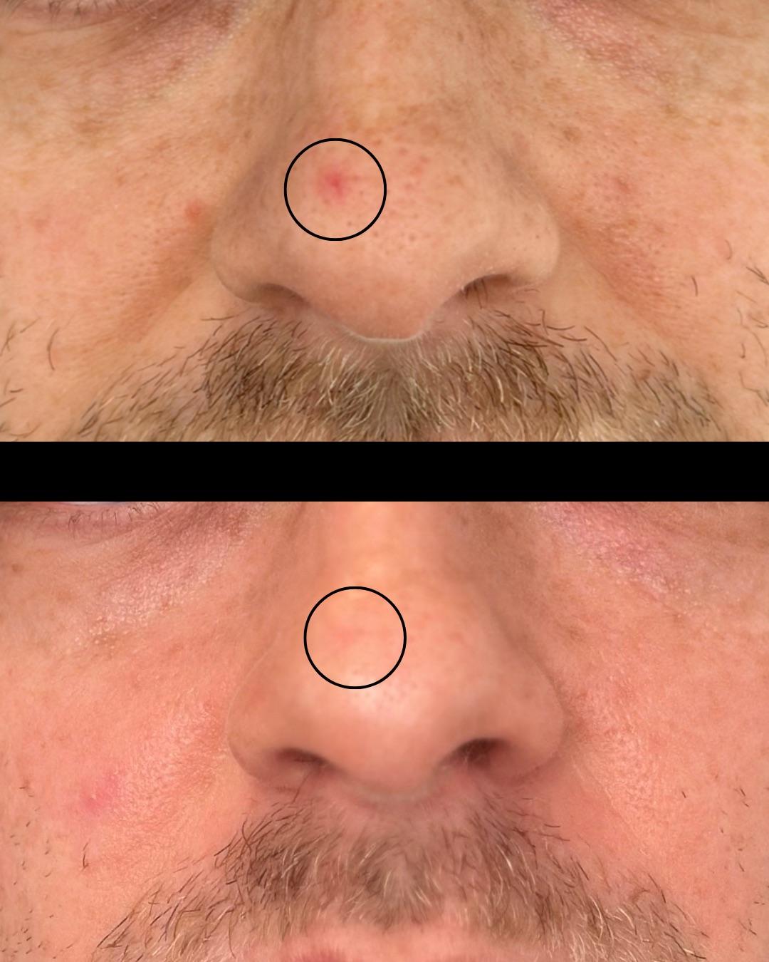 BBL HEROic Spot Treatment before and after