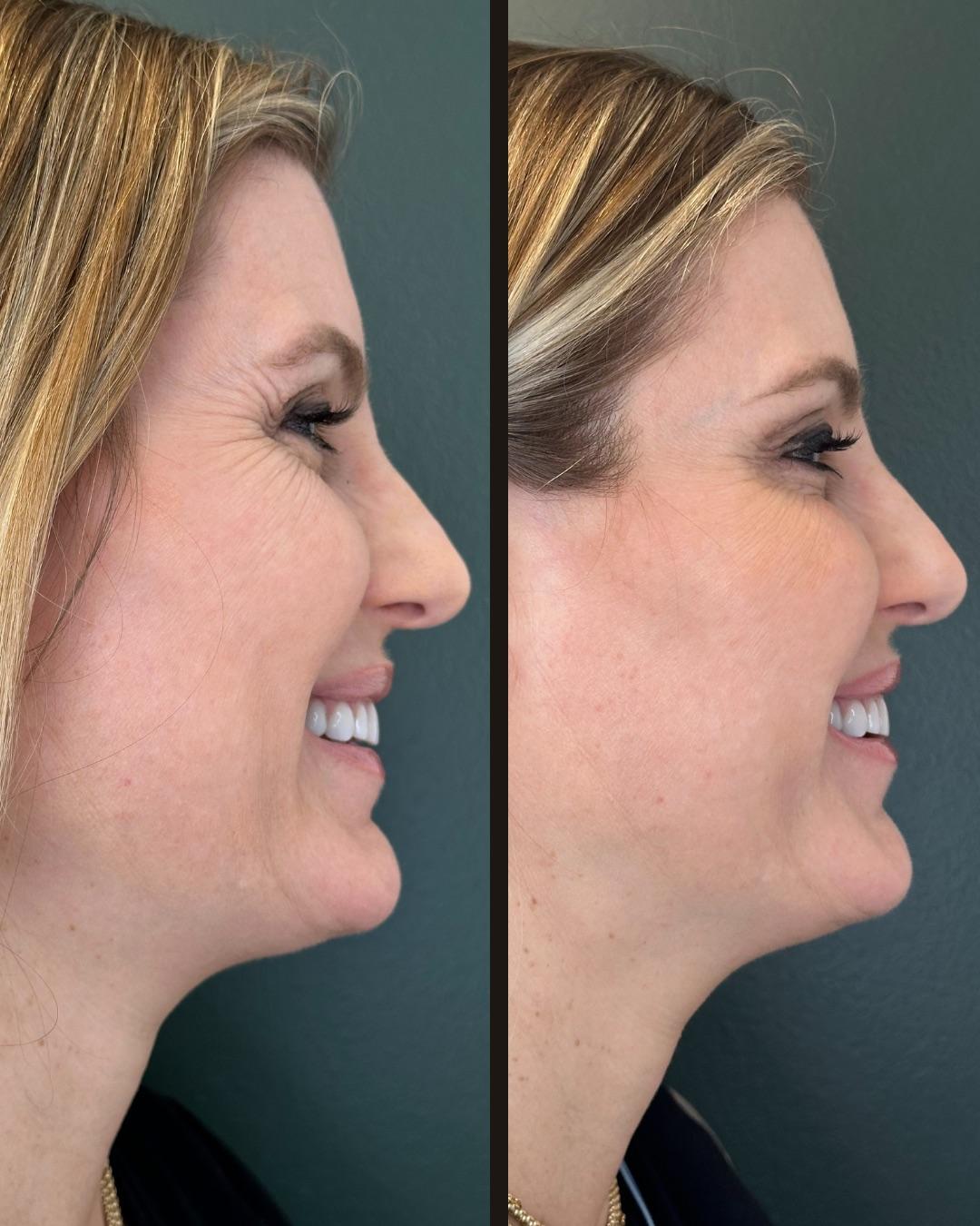 Botox before and after - Crow's feet