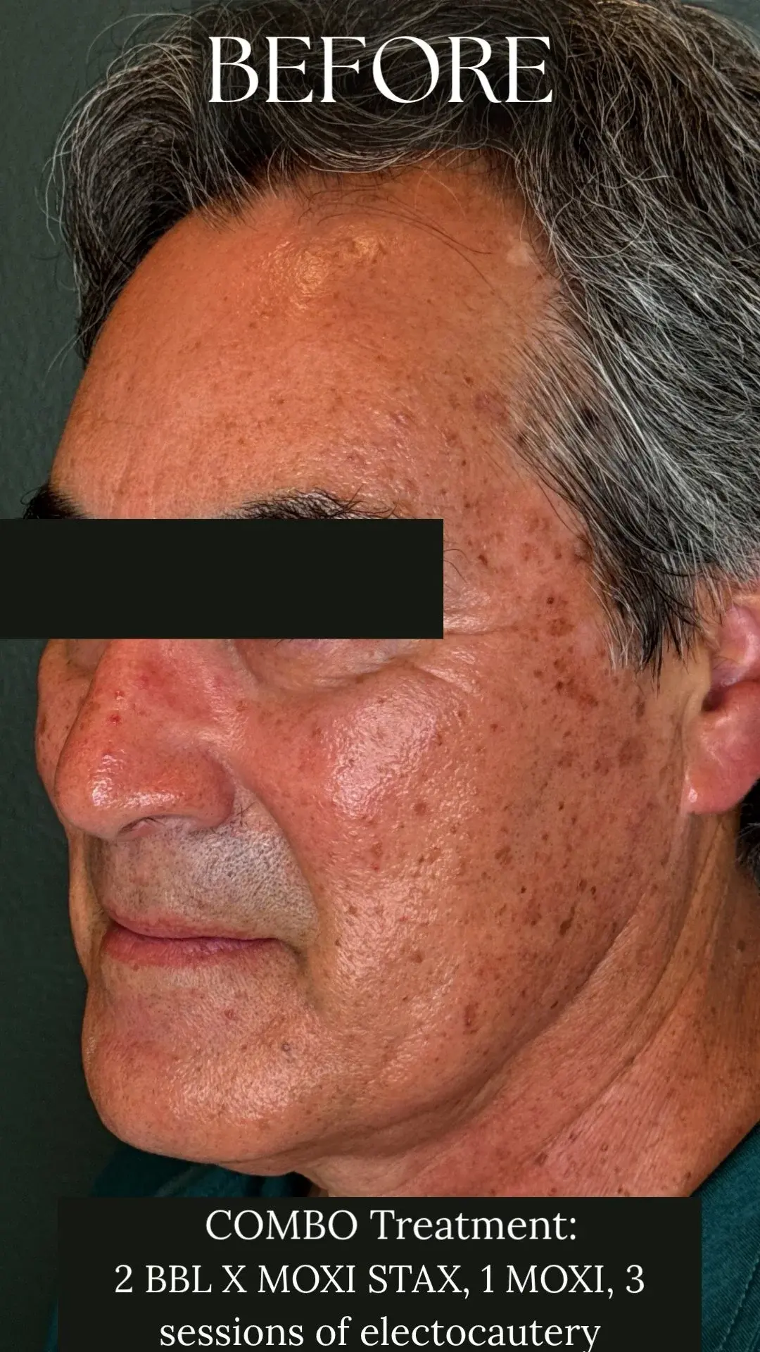 MOXI Treatment - Before